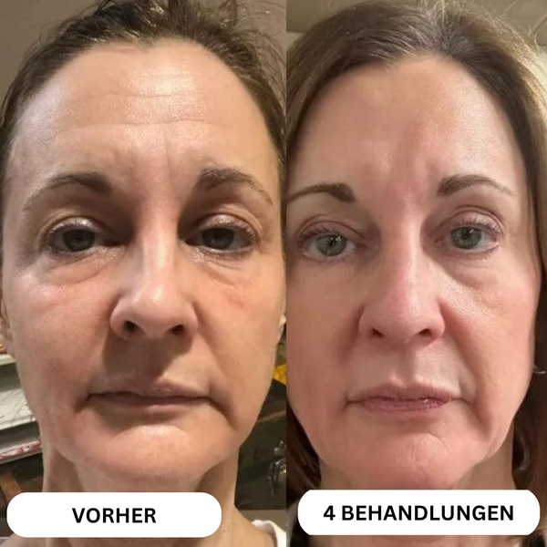 Système de micro-infusion de toxine botulique naturelle sur 8 semaines™