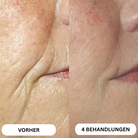 Système de micro-infusion de toxine botulique naturelle sur 8 semaines™