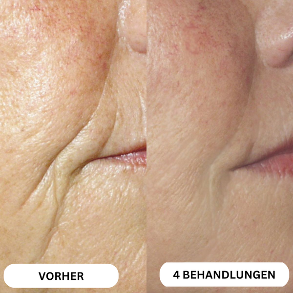 Système de micro-infusion de toxine botulique naturelle sur 8 semaines™