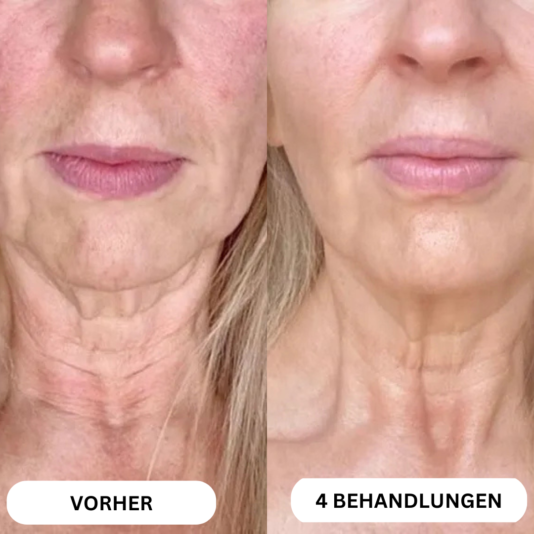 Natural Botulin 8-Wochen-Microinfusion-System™