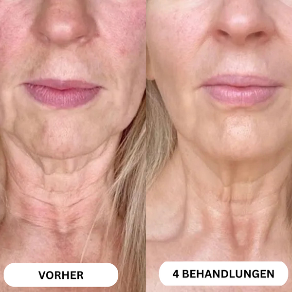 Système de micro-infusion de toxine botulique naturelle sur 8 semaines™