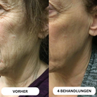 Système de micro-infusion de toxine botulique naturelle sur 8 semaines™