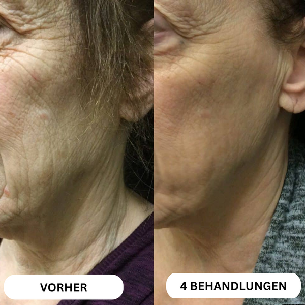 Système de micro-infusion de toxine botulique naturelle sur 8 semaines™