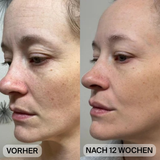 Natural Botulin LED-Infrarot-Maske